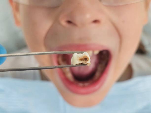 Best Chipped Tooth Repair Near Me  in Sun Village, CA